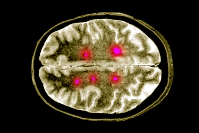 Framed Print : Brain scan of MS