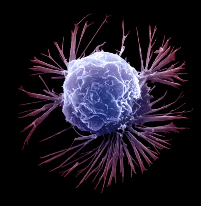 Framed Print : Breast Cancer Cell Framed Print : Breast Cancer Cell