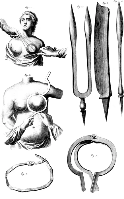 Framed Print : Breast Surgery Instruments, 1772 Framed Print : Breast Surgery Instruments, 1772