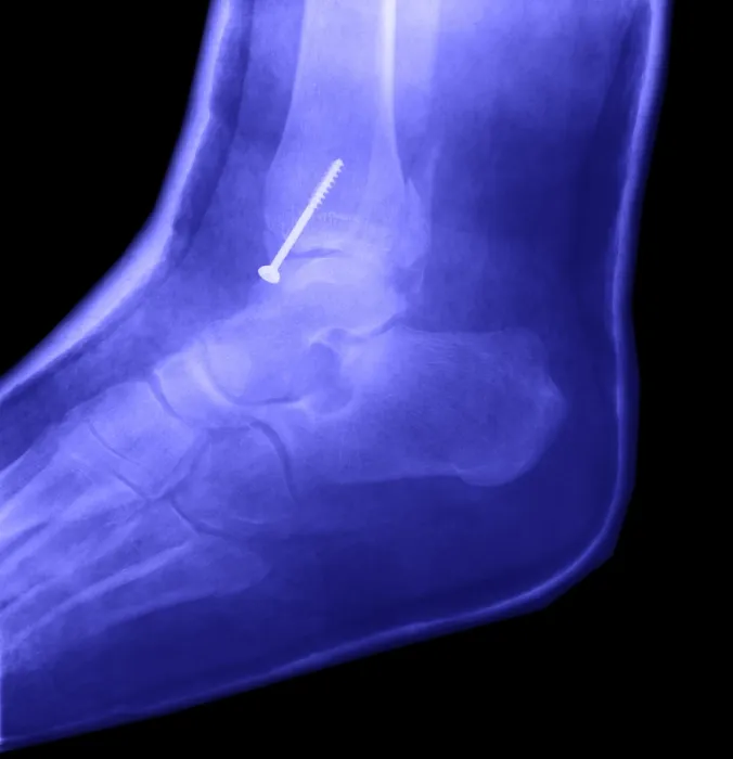 Framed Print : Broken Ankle