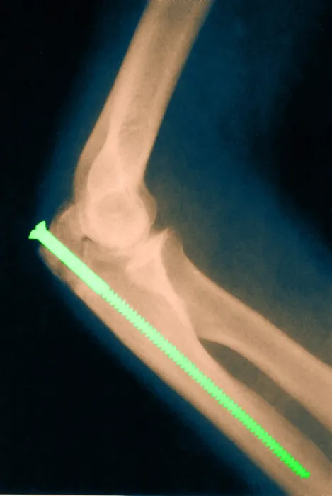 Framed Print : Broken Arm with Metal Pin, X-Ray Framed Print : Broken Arm with Metal Pin, X-Ray