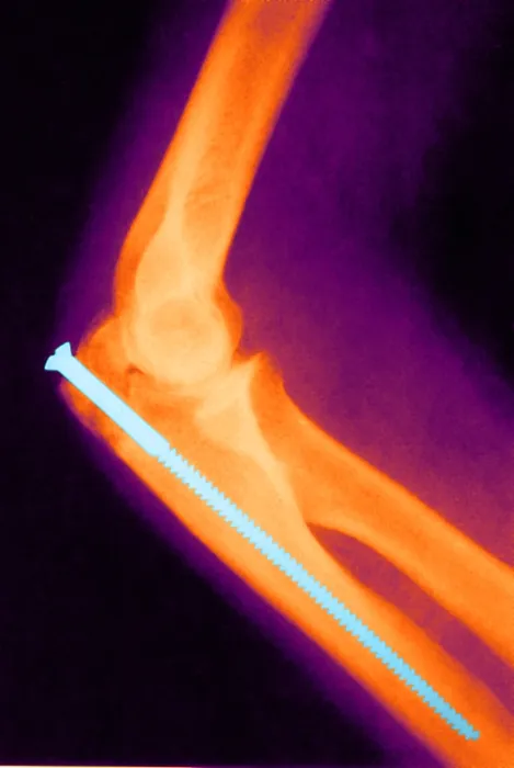 Framed Print : Broken Arm with Metal Pin, X-Ray Framed Print : Broken Arm with Metal Pin, X-Ray