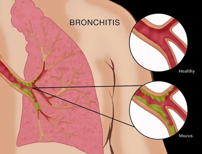 Framed Print : Bronchitis Framed Print : Bronchitis