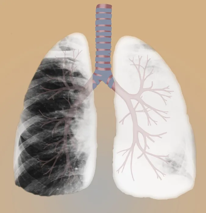 Framed Print : Bronchus Cancer Framed Print : Bronchus Cancer