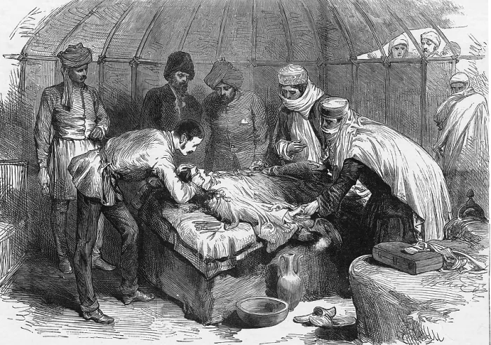 Framed Print : Burn Surgery, 1885 Framed Print : Burn Surgery, 1885