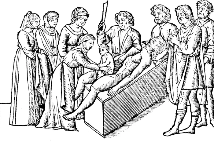 Framed Print : Caesarean Section, 16th Century Framed Print : Caesarean Section, 16th Century
