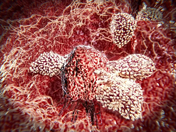 Framed Print : Cancer cell attacked by lymphocytes Framed Print : Cancer cell attacked by lymphocytes