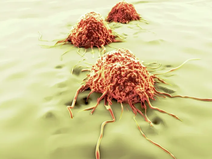 Framed Print : Cancer cells, artwork