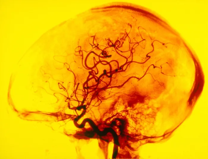 Framed Print : Cerebral Angiogram Framed Print : Cerebral Angiogram
