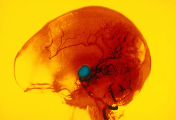 Framed Print : Cerebral Angiogram Framed Print : Cerebral Angiogram