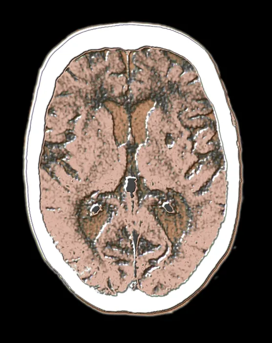 Framed Print : Cerebral CAT scan showing atrophy