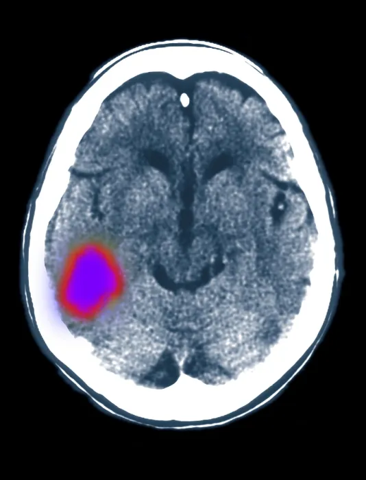 Framed Print : Cerebral CT scan showing stroke