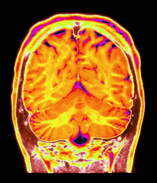 Framed Print : Cerebral MRI Framed Print : Cerebral MRI