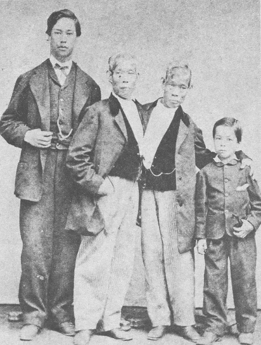Framed Print : Chang and Eng, Original Siamese Twins Framed Print : Chang and Eng, Original Siamese Twins