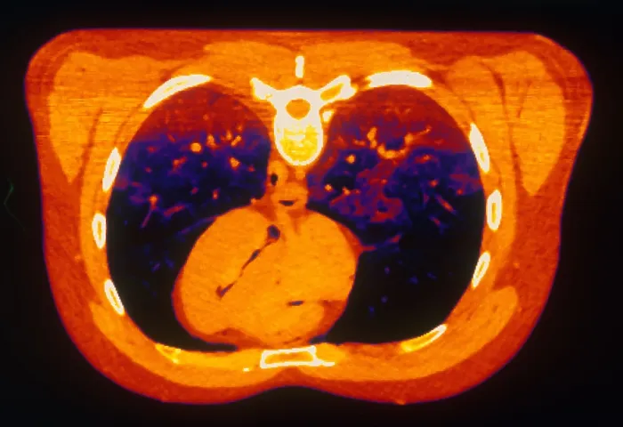 Framed Print : Chest & Heart, CT Scan Framed Print : Chest & Heart, CT Scan