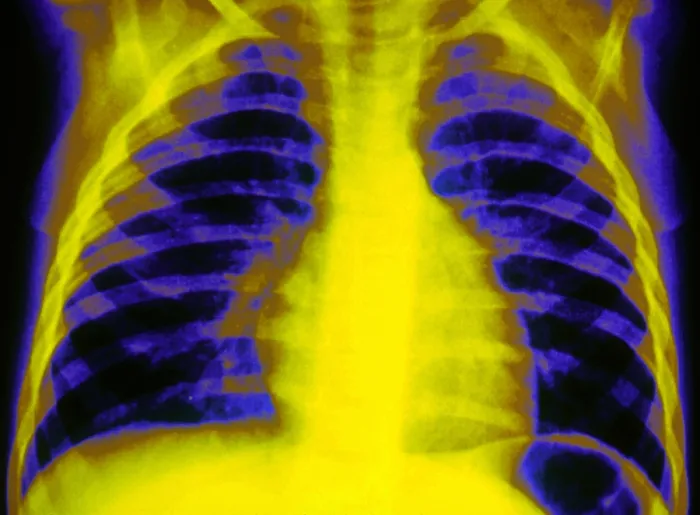Framed Print : Chest X-ray Framed Print : Chest X-ray