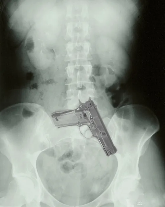 Framed Print : Chest x-ray showing hidden gun