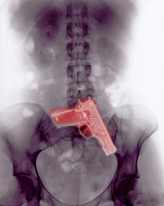 Framed Print : Chest x-ray showing hidden gun