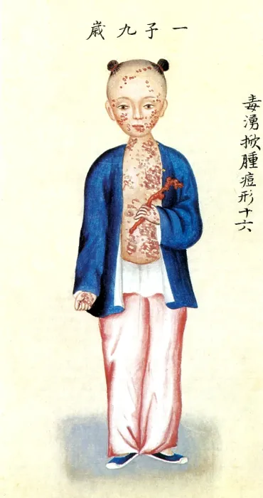 Framed Print : Chinese Smallpox Victim Framed Print : Chinese Smallpox Victim