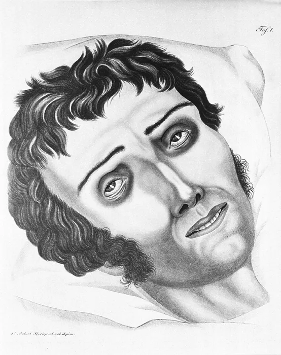 Framed Print : Cholera Victim, 1831