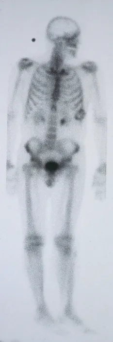 Framed Print : Chondrosarcoma Framed Print : Chondrosarcoma