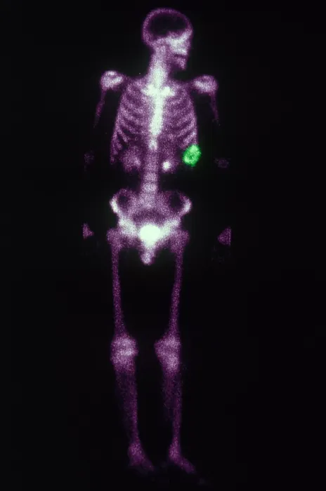 Framed Print : Chondrosarcoma Framed Print : Chondrosarcoma