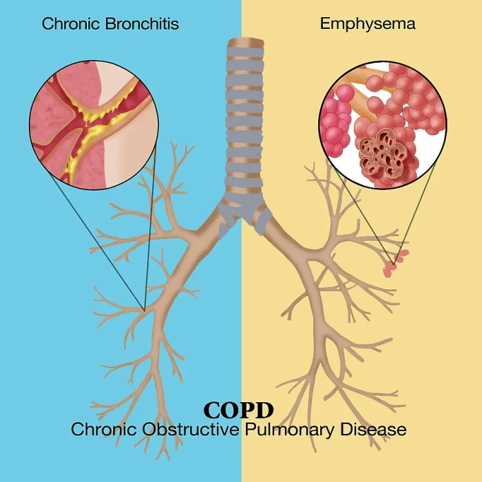 Framed Print : Chronic Obstructive Pulmonary Disease (COPD)