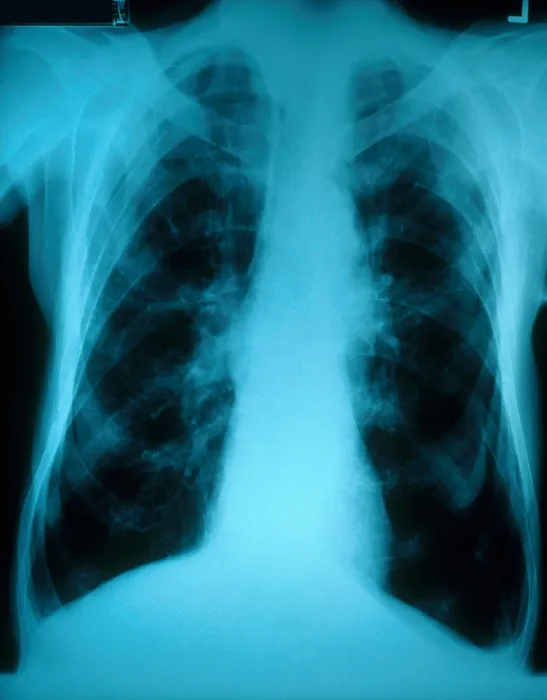 Framed Print : Chronic Obstructive Pulmonary Disease (X-ray) Framed Print : Chronic Obstructive Pulmonary Disease (X-ray)