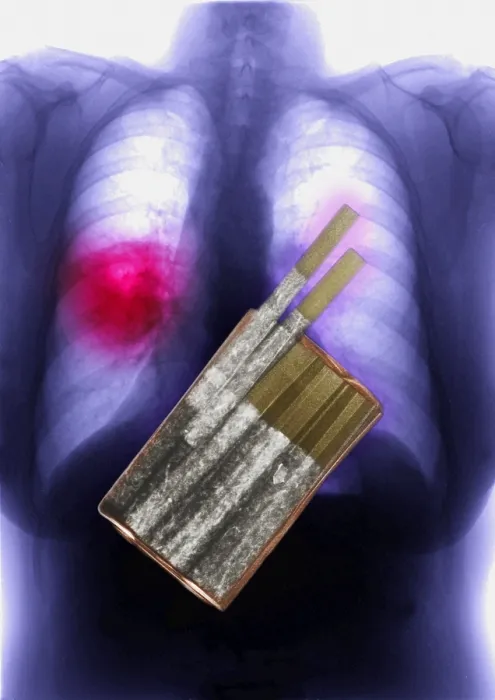 Framed Print : Cigarettes and Lung Cancer