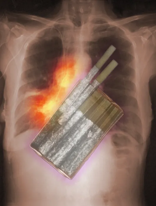 Framed Print : Cigarettes and Lung Cancer Framed Print : Cigarettes and Lung Cancer