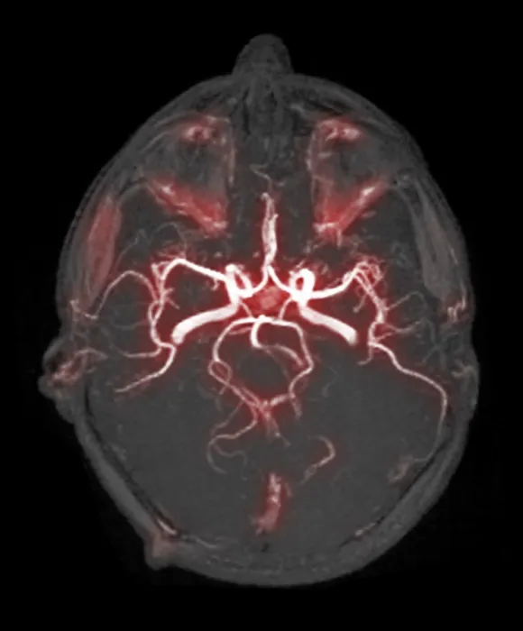 Framed Print : Circle of Willis, Angiogram Framed Print : Circle of Willis, Angiogram