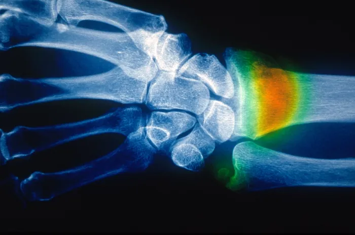 Framed Print : Colles Fracture, X-ray