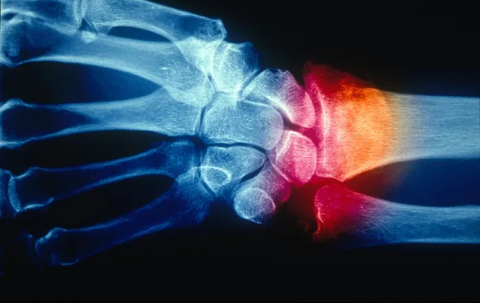 Framed Print : Colles Fracture, X-ray