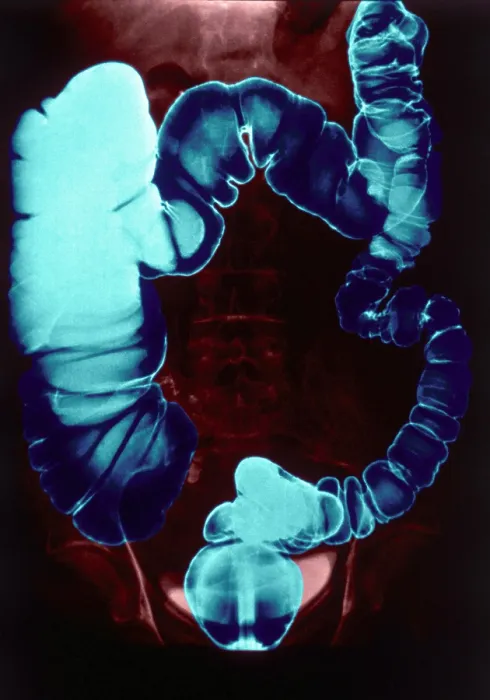 Framed Print : Colon Examination, Barium Enema