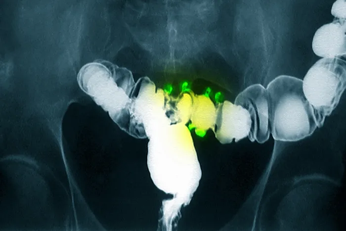 Framed Print : Colon x-ray with barium contrast