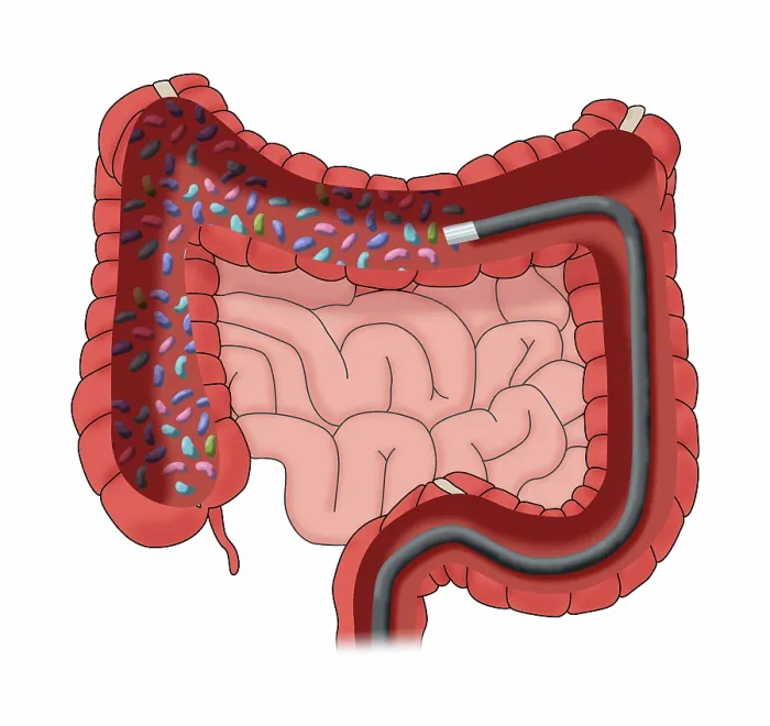 Framed Print : Colonoscopy Administering a Fecal Microbiota Transplantation (FMT) in the large intestine to improve the human microbiome, medical illustration Framed Print : Colonoscopy Administering a Fecal Microbiota Transplantation (FMT) in the large intestine to improve the human microbiome, medical illustration