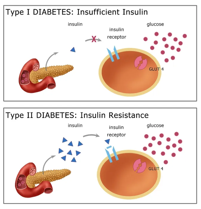 Framed Print : Comparative diagram of type I diabetes and type II diabetes, insulin, glucose, GLUT4 transporter protein, pancreas, medical illustration Framed Print : Comparative diagram of type I diabetes and type II diabetes, insulin, glucose, GLUT4 transporter protein, pancreas, medical illustration