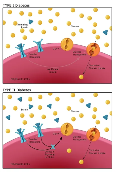 Framed Print : Comparative diagram of type I diabetes and type II diabetes, insulin, glucose, GLUT4 transporter protein, pancreas, medical illustration Framed Print : Comparative diagram of type I diabetes and type II diabetes, insulin, glucose, GLUT4 transporter protein, pancreas, medical illustration