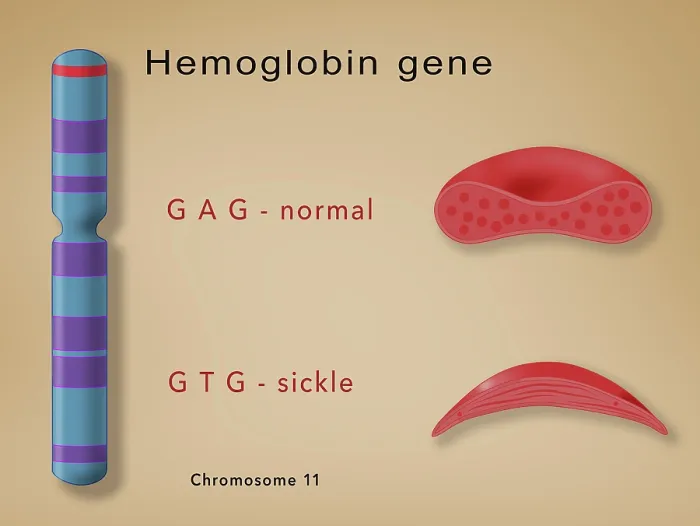 Framed Print : Comparison of hemoglobin in a sickle cell (sickle cell anemia disease) and a normal blood cell, it also illustrates the genetics of chromosome 11