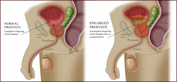 Framed Print : Comparison of Normal and Enlarged Prostate Framed Print : Comparison of Normal and Enlarged Prostate