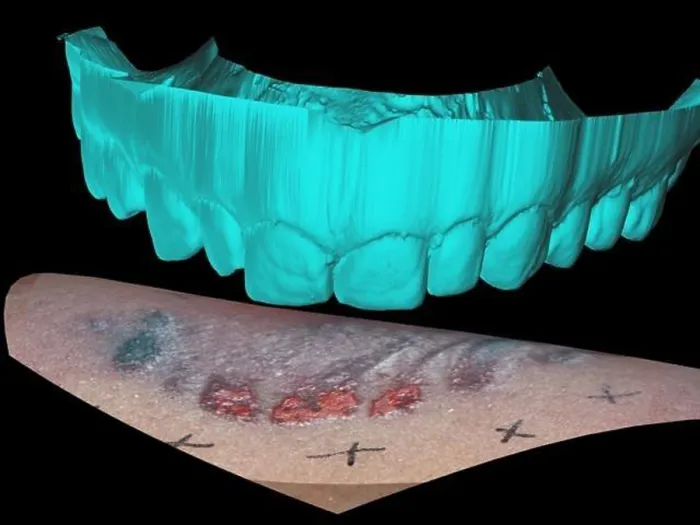 Framed Print : Computer Reconstruction of Bite Mark