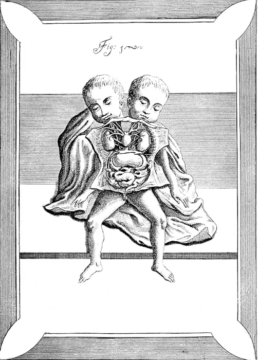 Framed Print : Conjoined Twins, 18th Century Framed Print : Conjoined Twins, 18th Century