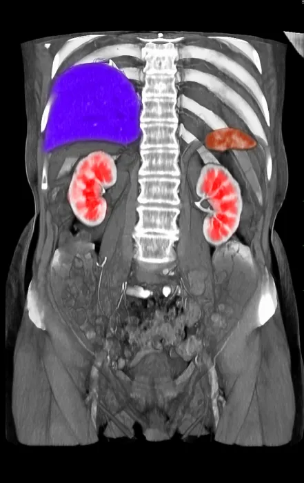 Framed Print : Coronal Reconstruction of CT Scan Showing Normal Anatomy