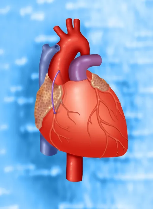 Framed Print : Coronary Vein Graft Framed Print : Coronary Vein Graft