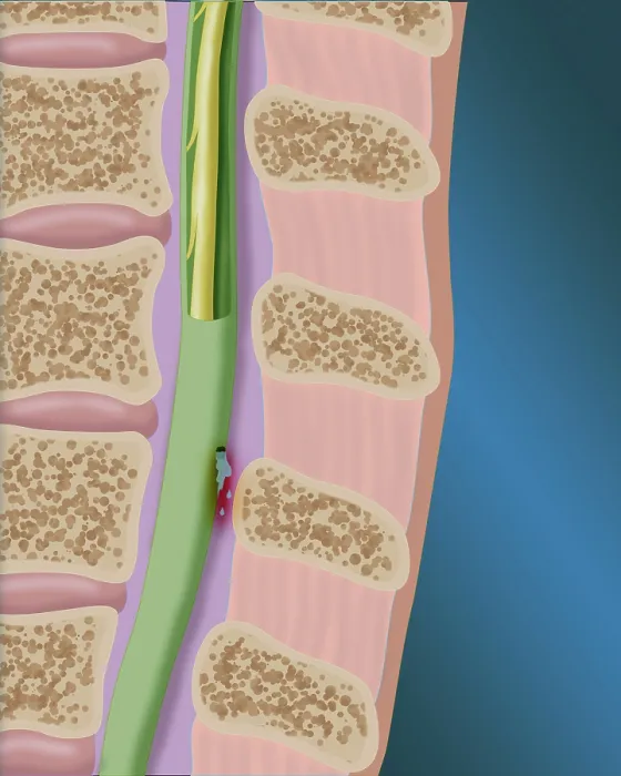 Framed Print : CSF Leak in the Spinal Cord Framed Print : CSF Leak in the Spinal Cord