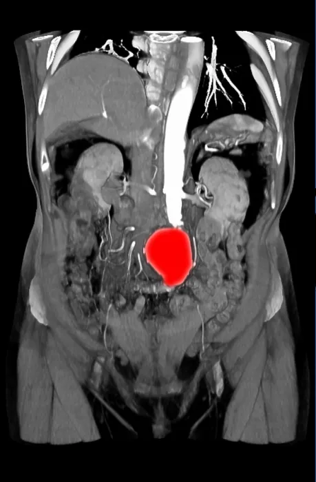 Framed Print : CT Scan of Abdominal Aortic Aneurysm