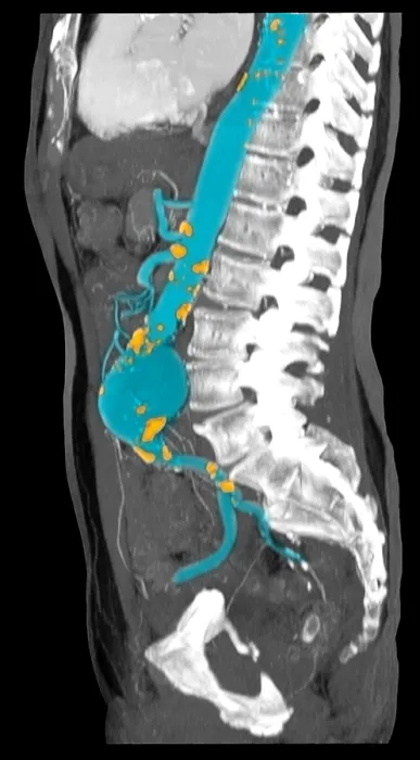 Framed Print : CT Scan of Abdominal Aortic Aneurysm