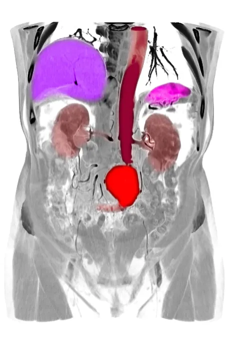 Framed Print : CT Scan of Abdominal Aortic Aneurysm