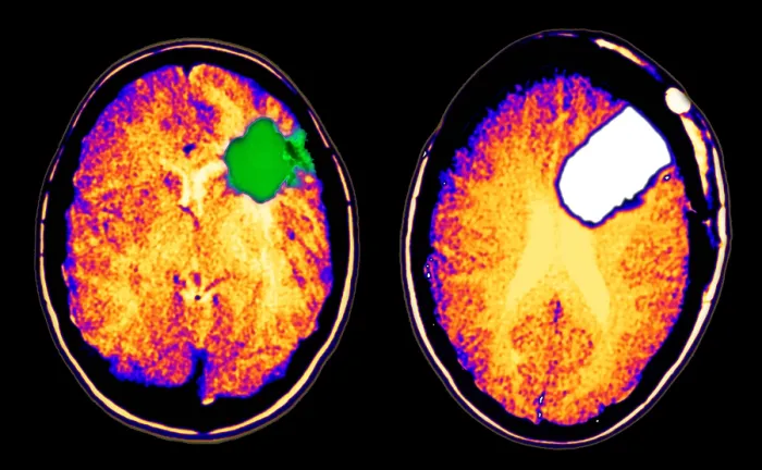 Framed Print : CT scan of brain glioma and tumor removal Framed Print : CT scan of brain glioma and tumor removal