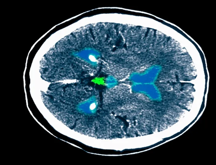 Framed Print : CT scan of a normal brain Framed Print : CT scan of a normal brain
